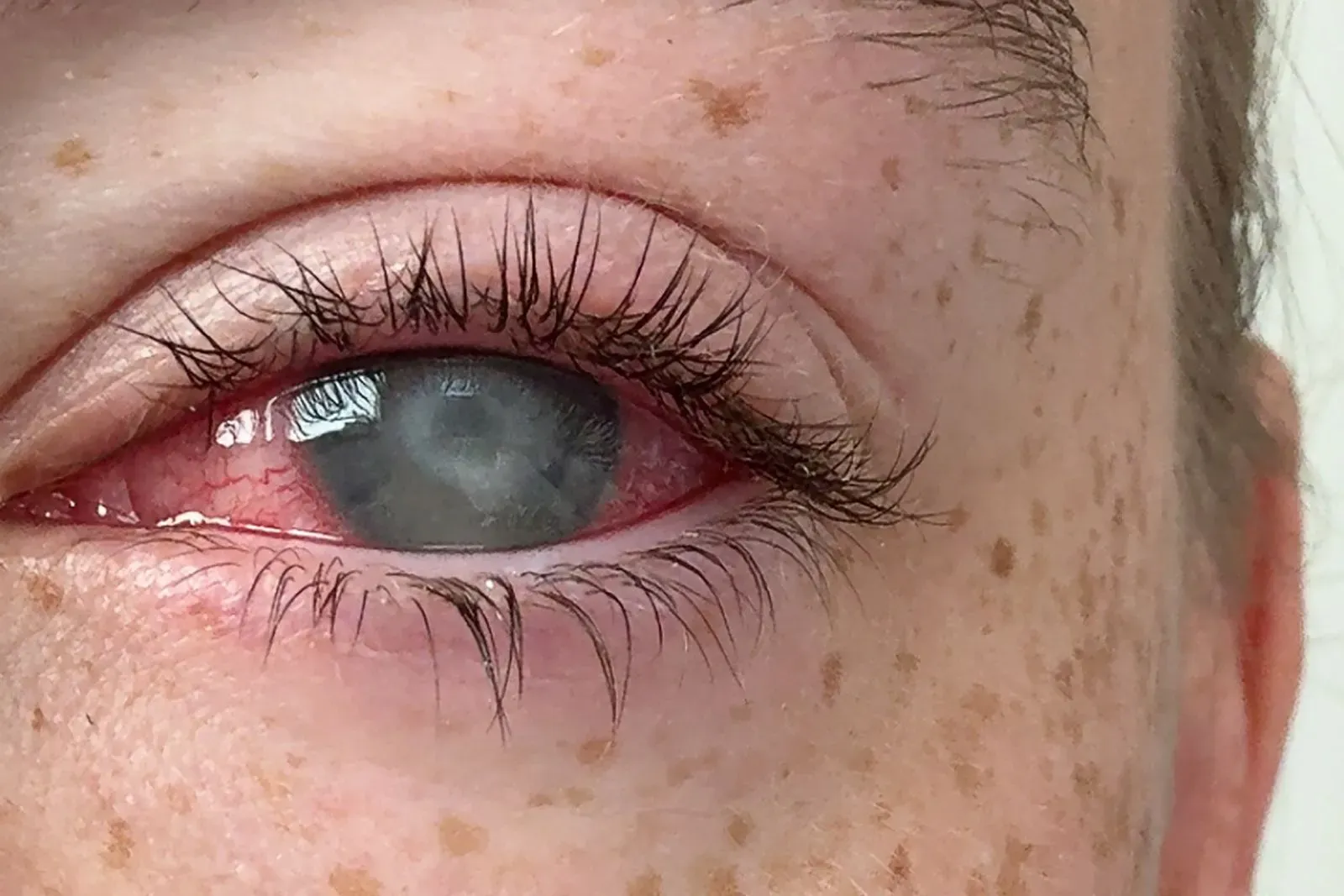 عين مصابة بالتهاب القرنية الشوكميبا، تظهر احمرارًا واضحًا وتورمًا حول القرنية، مما يعكس الألم والمشاكل الصحية المرتبطة بالعدسات اللاصقة.