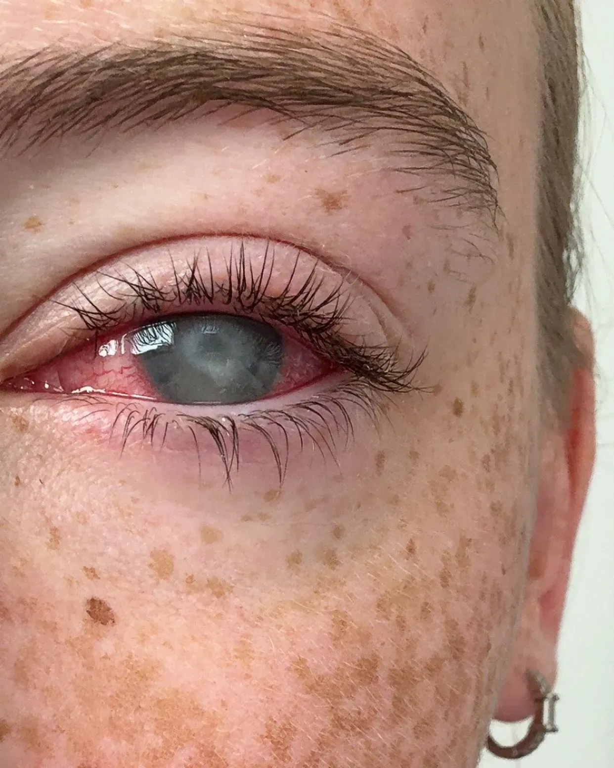 عين حمراء مع احمرار حول الجفن، تظهر عليها علامات التهاب، مما يشير إلى حالة التهاب القرنية الشوكميبا.