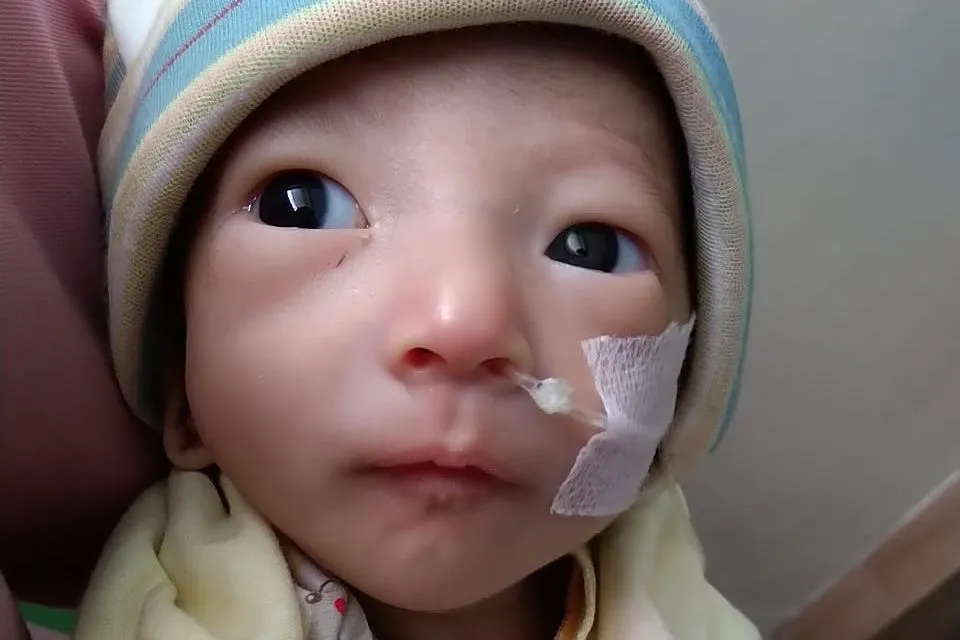 رضيع يعاني من متلازمة القولون القصير الخلقي، مع أنبوب تغذية أنفي، يعكس تحديات مقاومة المضادات الحيوية في علاج العدوى.