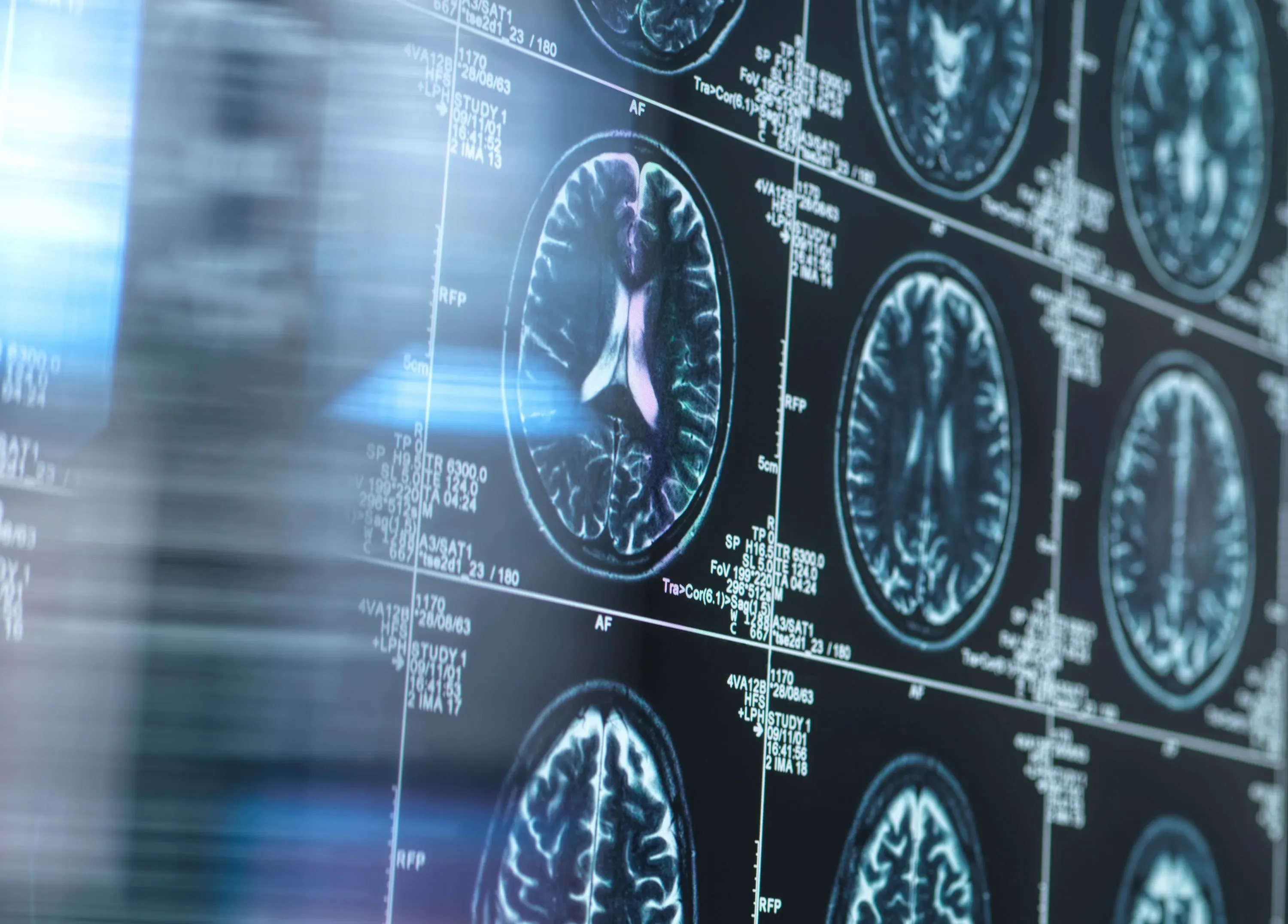 صور الأشعة السينية لدماغ تظهر التغيرات المرتبطة بمرض الزهايمر، مع التركيز على أهمية الليثيوم في صحة الدماغ.