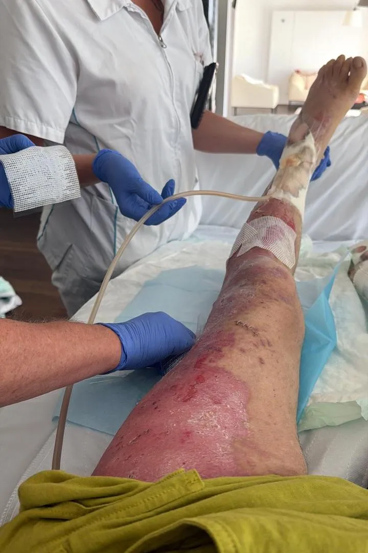إصابة شديدة في ساق فاديم يرمولاييف بعد انفجار قنبلة في موناكو، تظهر الجروح والضمادات أثناء تلقي العلاج الطبي.