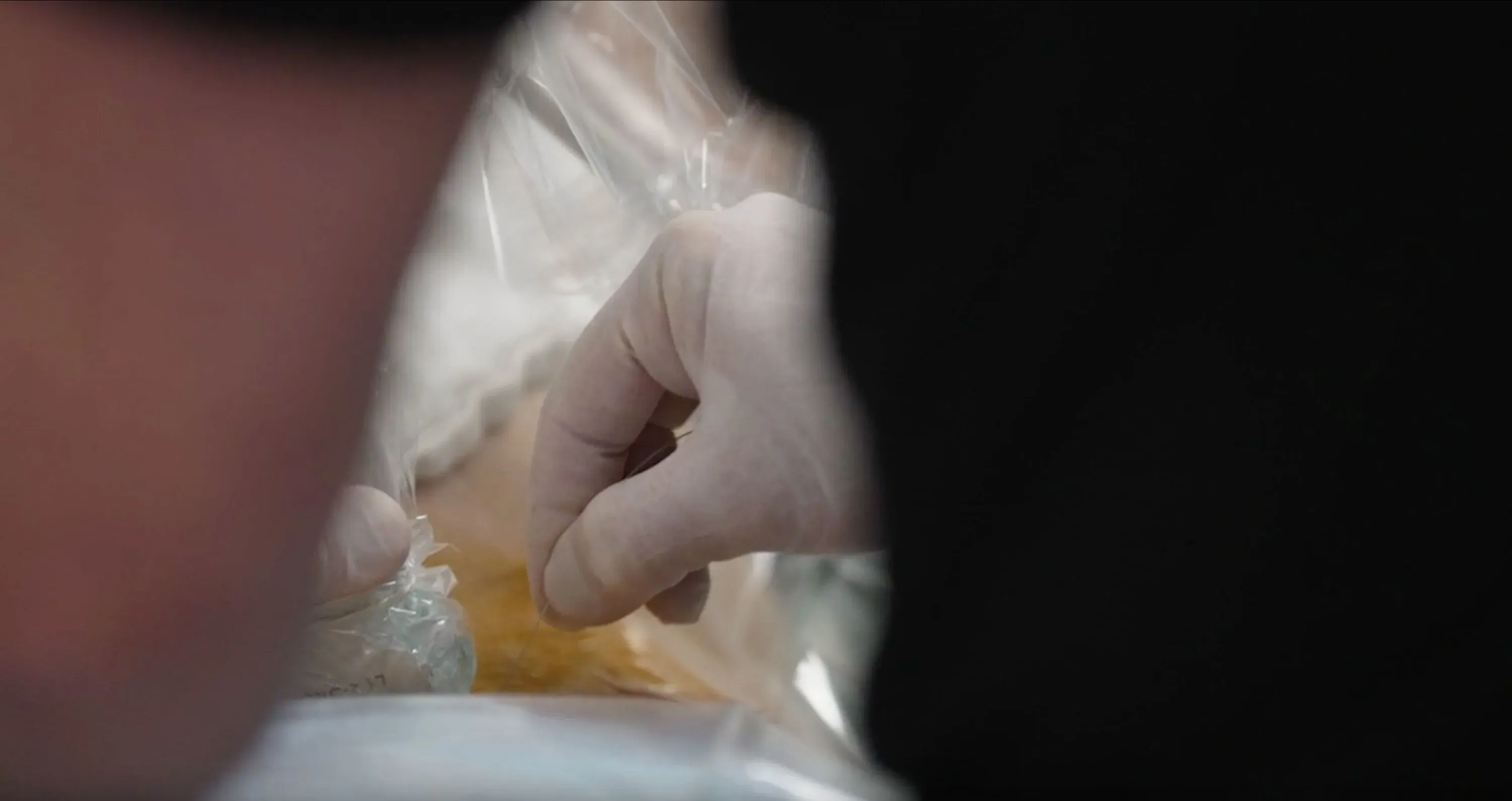 يد تظهر يد طبيب ترتدي قفازًا، وهي تحضر علاجًا أو إجراءً طبيًا، مما يعكس أهمية تخفيف الألم والتقنيات المستخدمة في الرعاية الصحية.