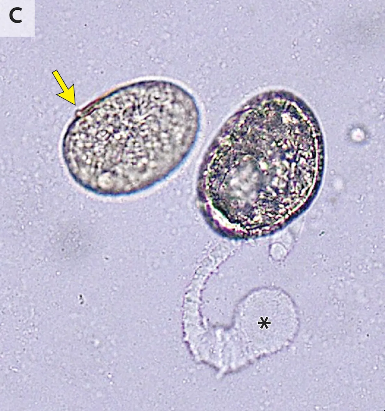 بيوض دودة Schistosoma japonicum تحت المجهر مع ظهور ترسيب حول البيضة يشير إلى عدوى داء البلهارسيا الدماغي.